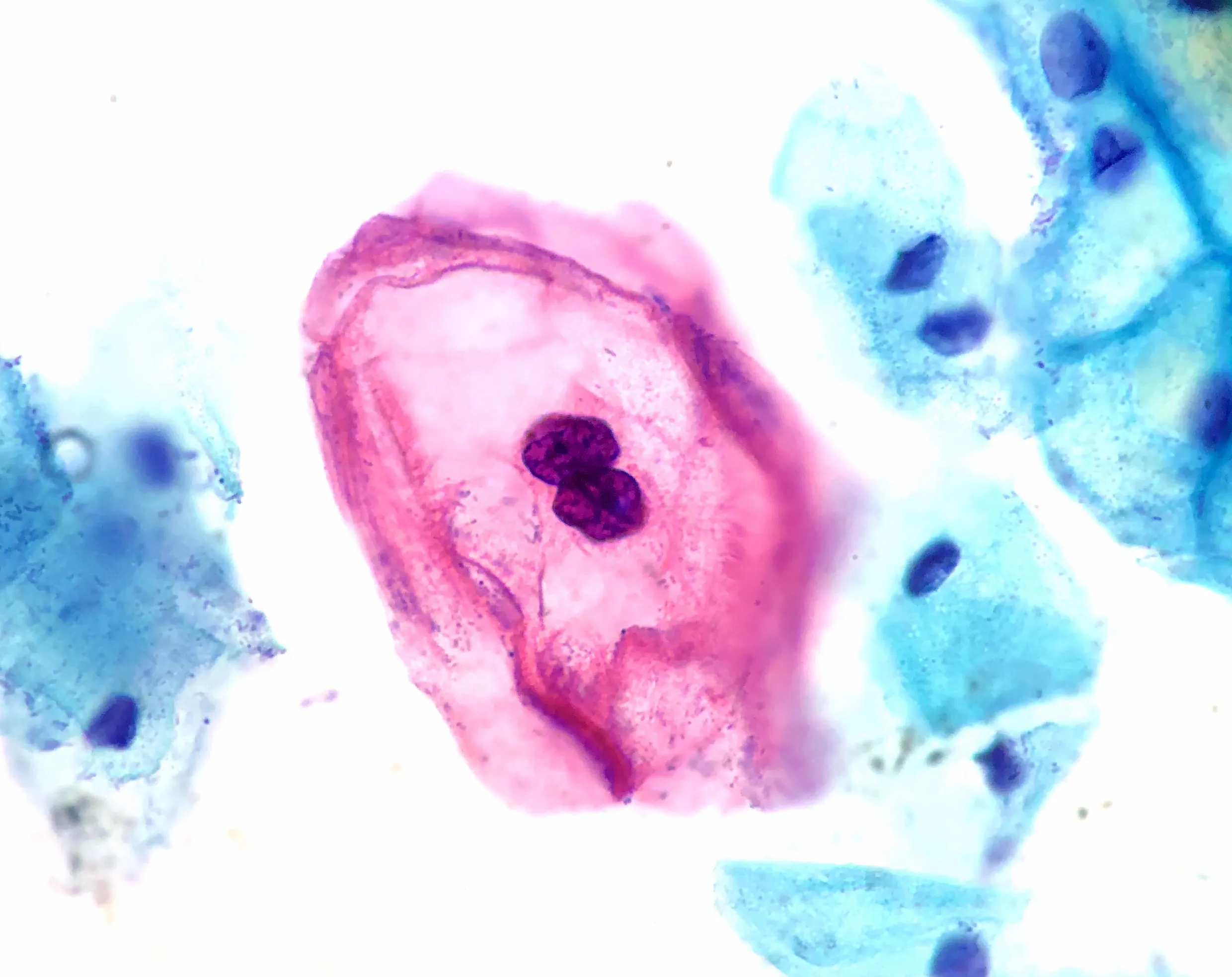 Micrografía de citología cervical con coilocitos, células con halo claro perinuclear por VPH