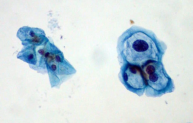 Citología ThinPrep: células escamosas sin cambios a la izquierda y células con efecto citopático por VPH a la derecha