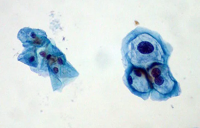Células del cuello uterino: normales y tomadas por el VPH, al microscopio