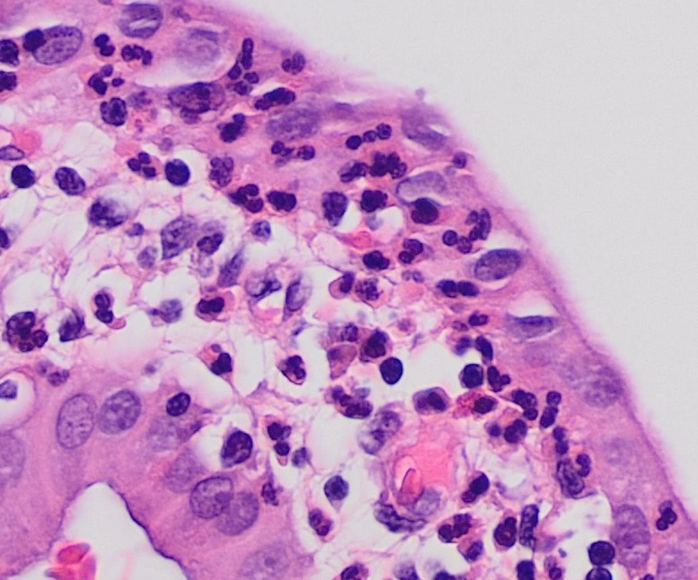 Micrografía H&E de colecistitis aguda con neutrófilos dentro de la pared de la vesícula biliar
