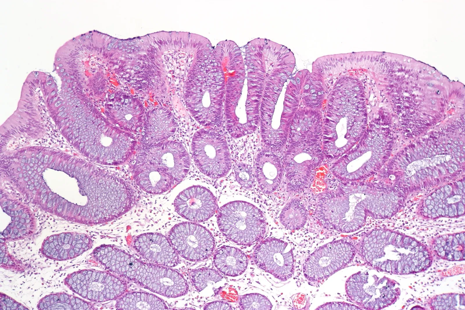 Adenoma tubular del colon al microscopio, junto a mucosa normal, con tinción de hematoxilina y eosina