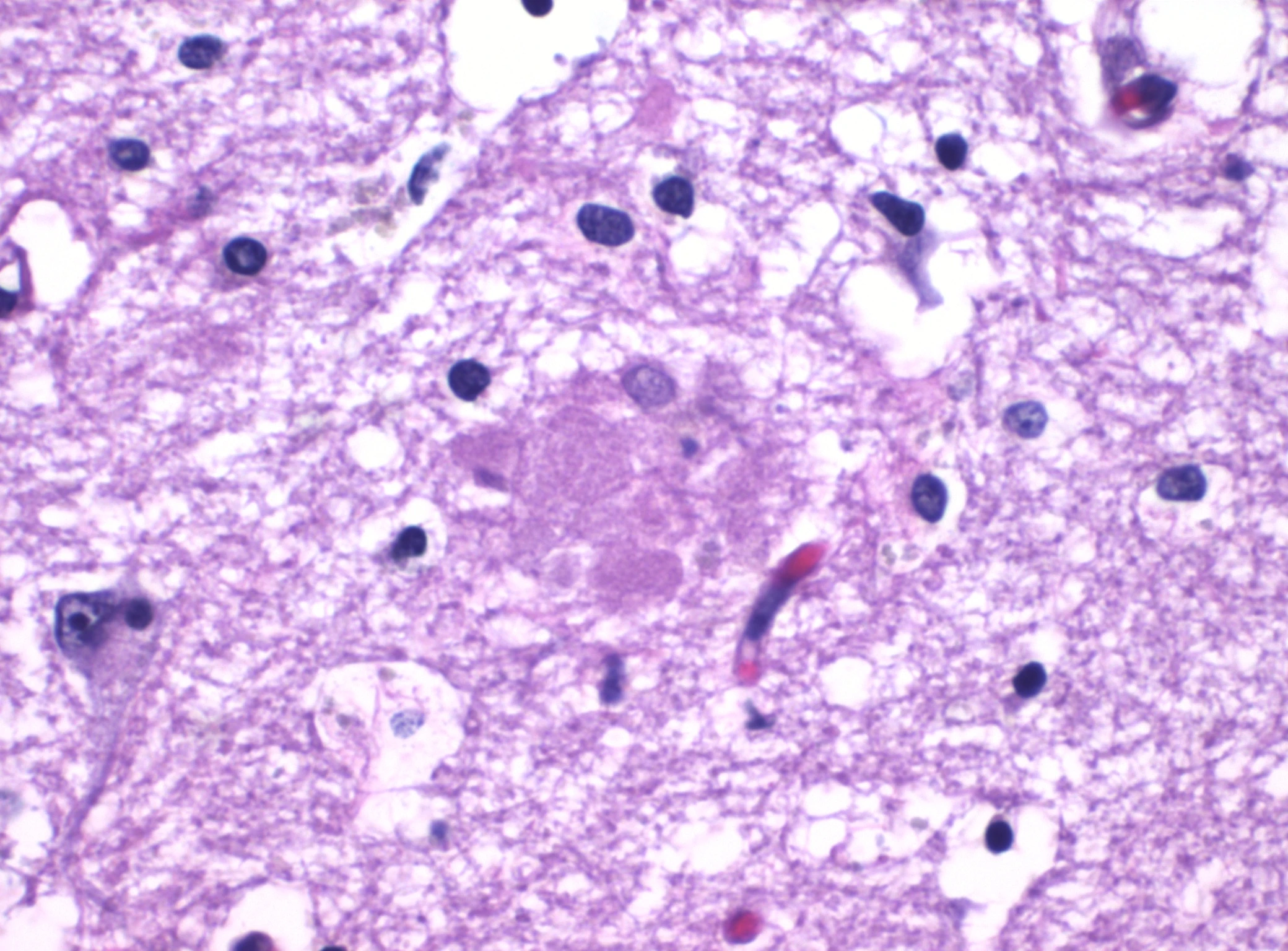 Micrografía H&E de una placa de beta-amiloide en el hipocampo con Alzheimer