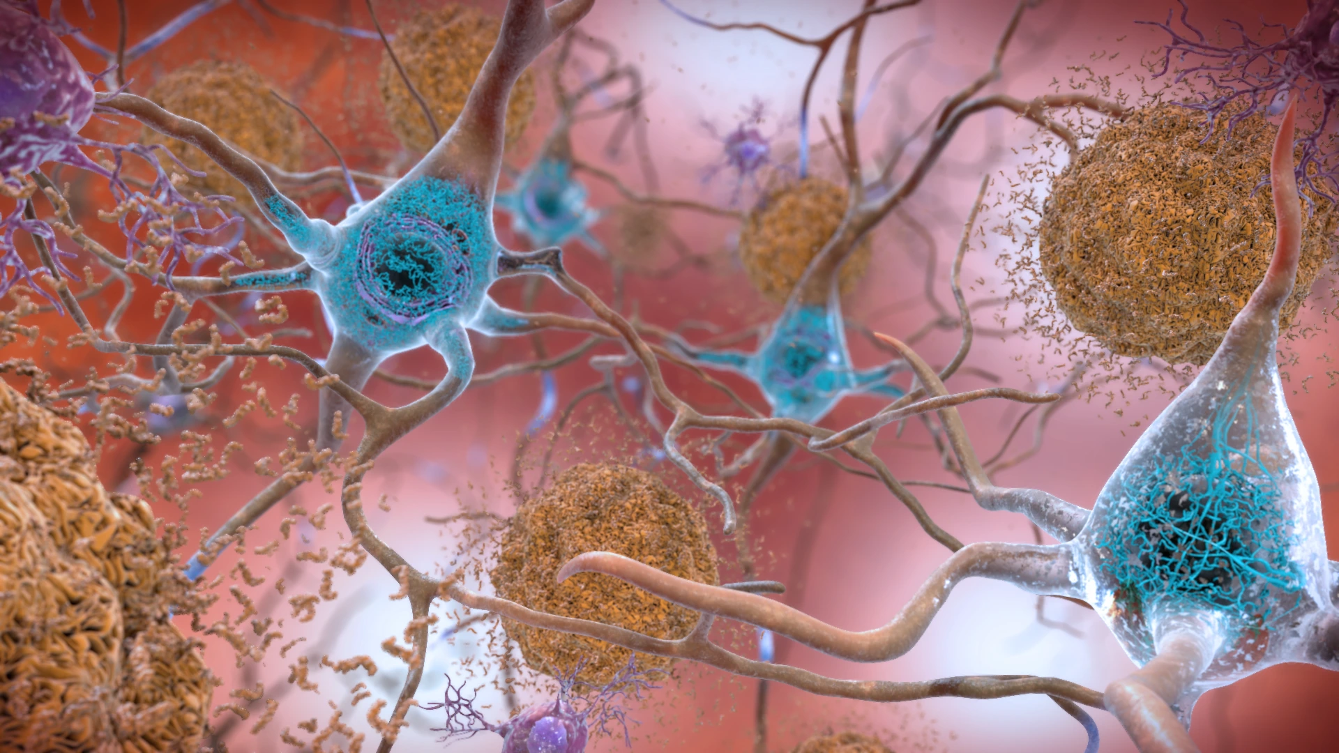 Ilustración con placas de beta-amiloide entre neuronas y ovillos de tau dentro de ellas