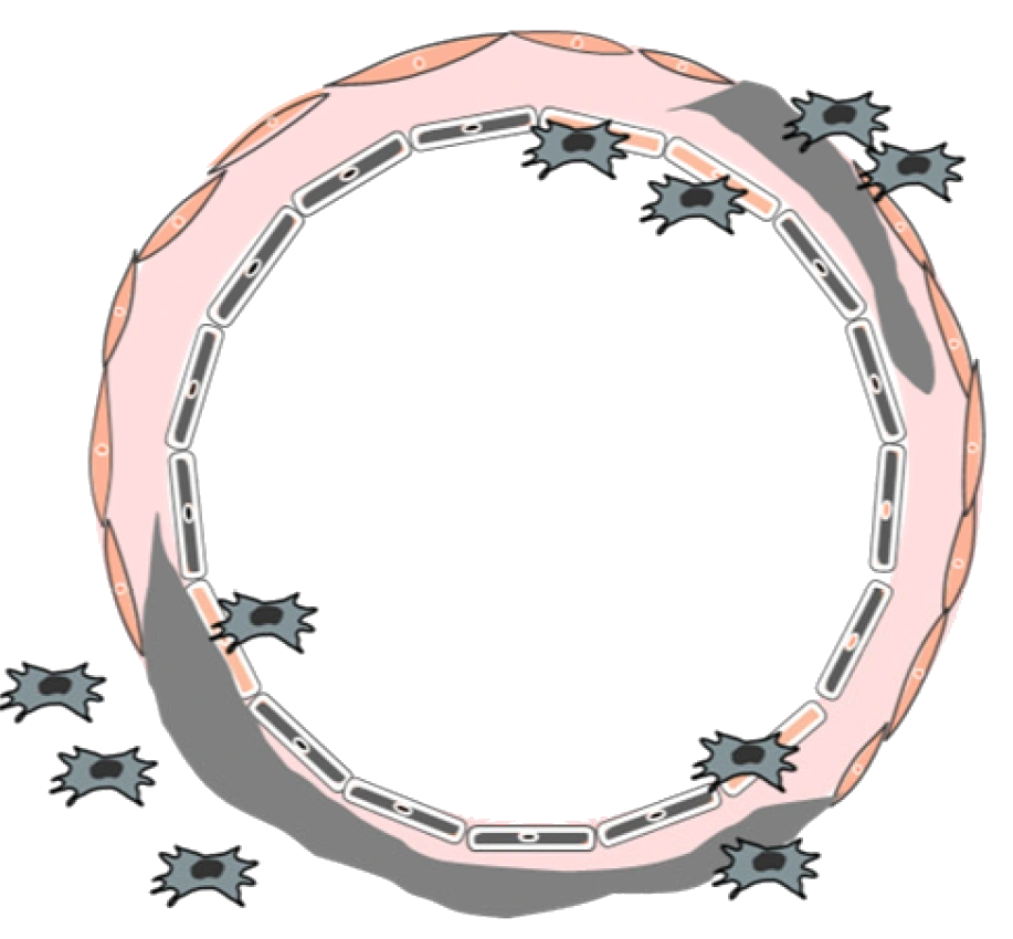 Arteria espiral en un embarazo sano: luz amplia, pared delgada con material fibrinoide y células de la placenta