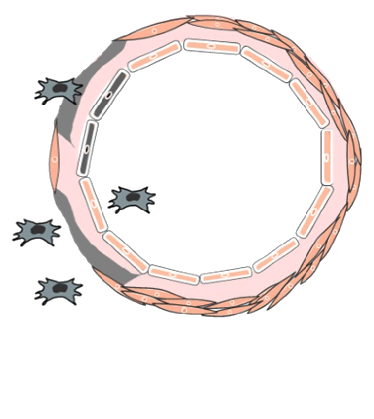 Arteria espiral en preeclampsia: luz más estrecha y pared que conserva su músculo, con células de la placenta que se quedaron afuera