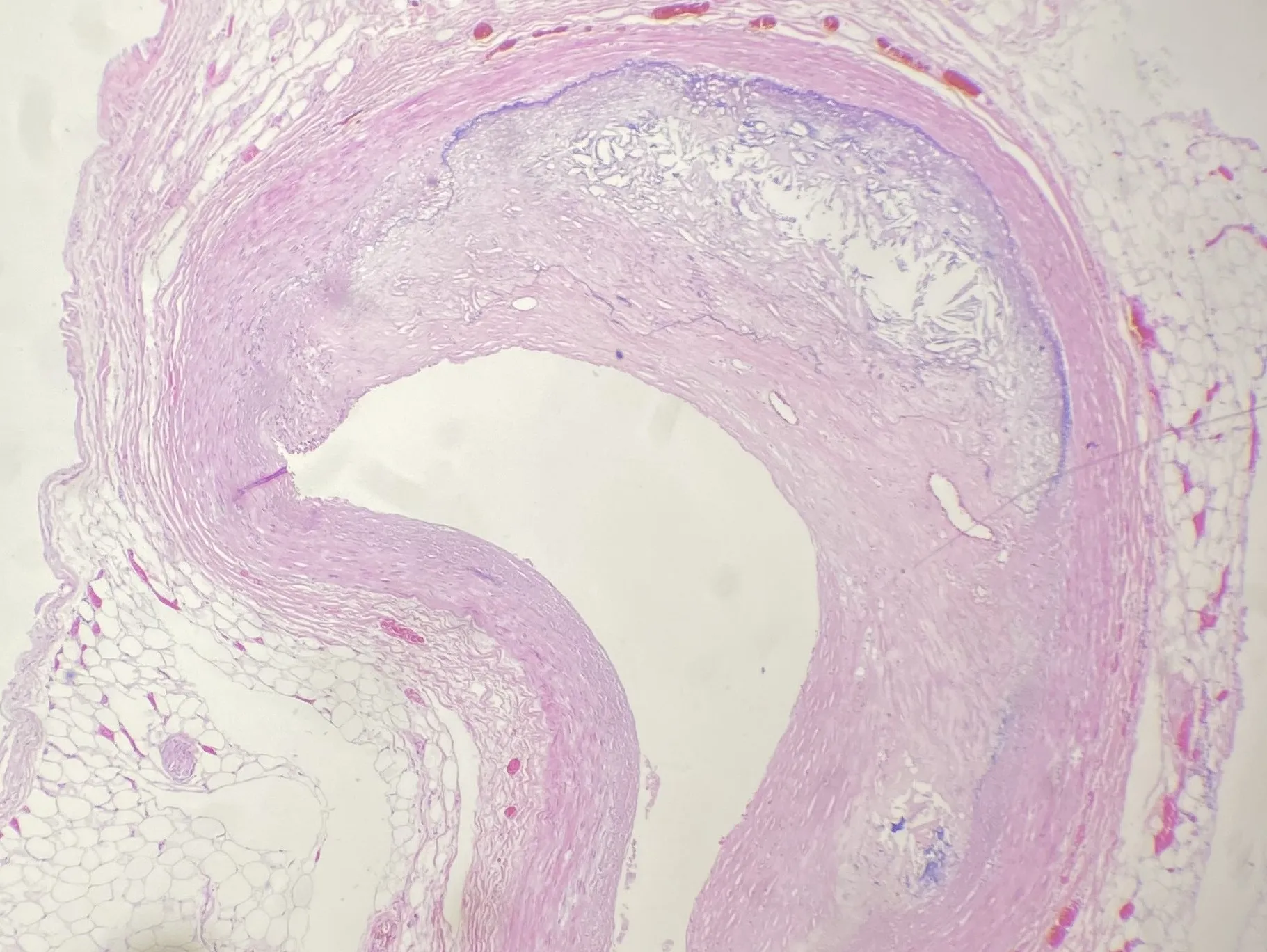 Micrografía de una arteria con placa de aterosclerosis y núcleo de colesterol