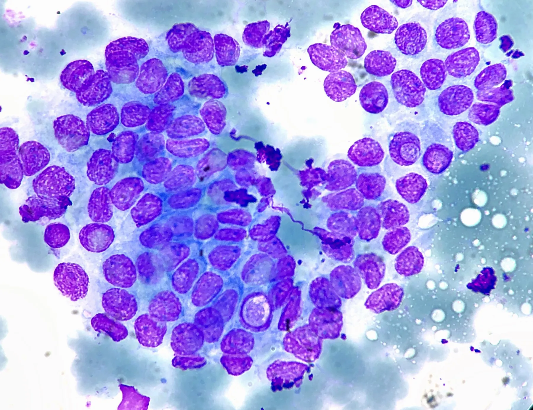 Citología de punción con aguja fina de un carcinoma papilar de tiroides, con grupos de células foliculares