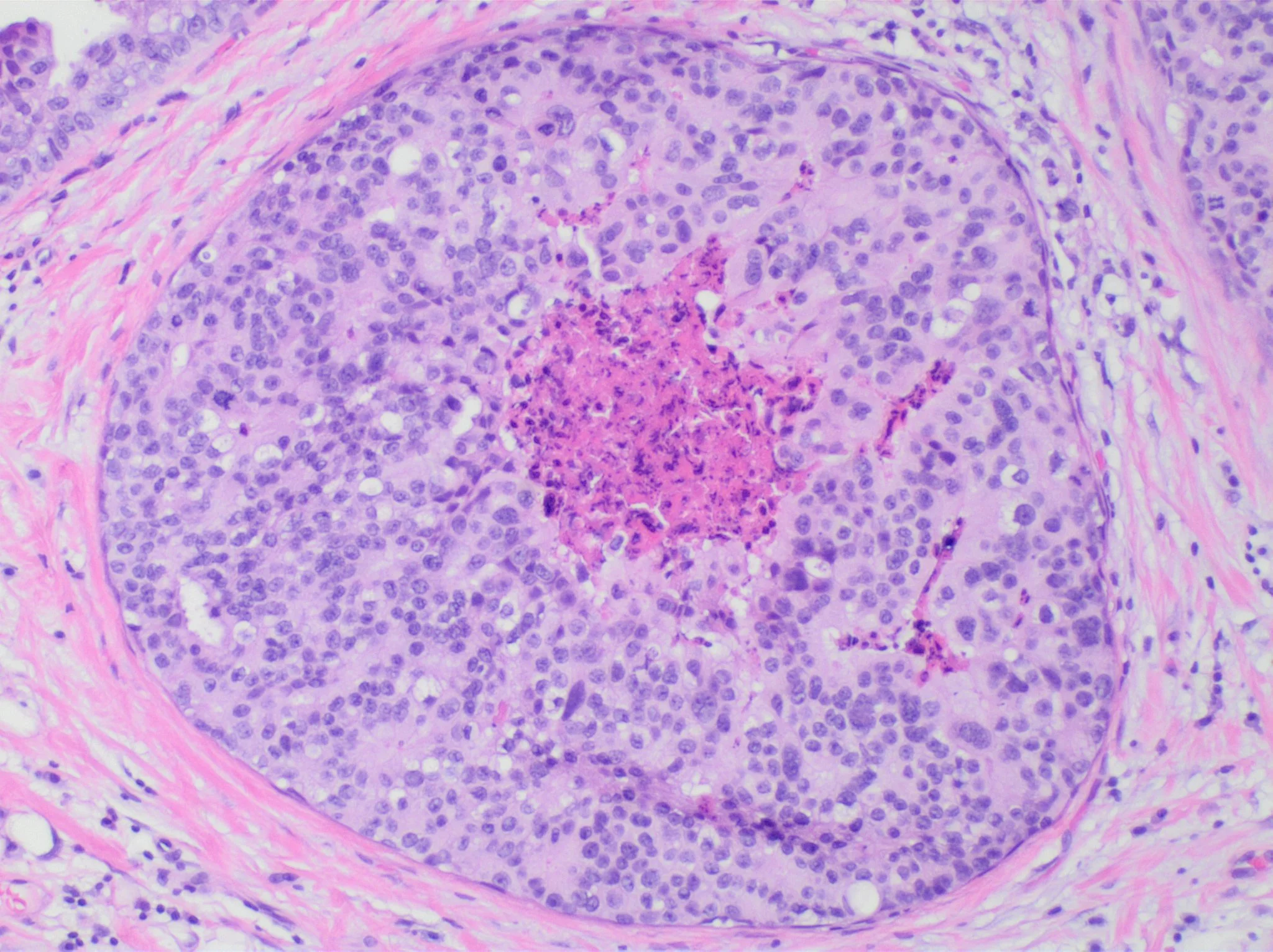 Micrografía H&E de un conducto mamario ocupado por carcinoma ductal in situ