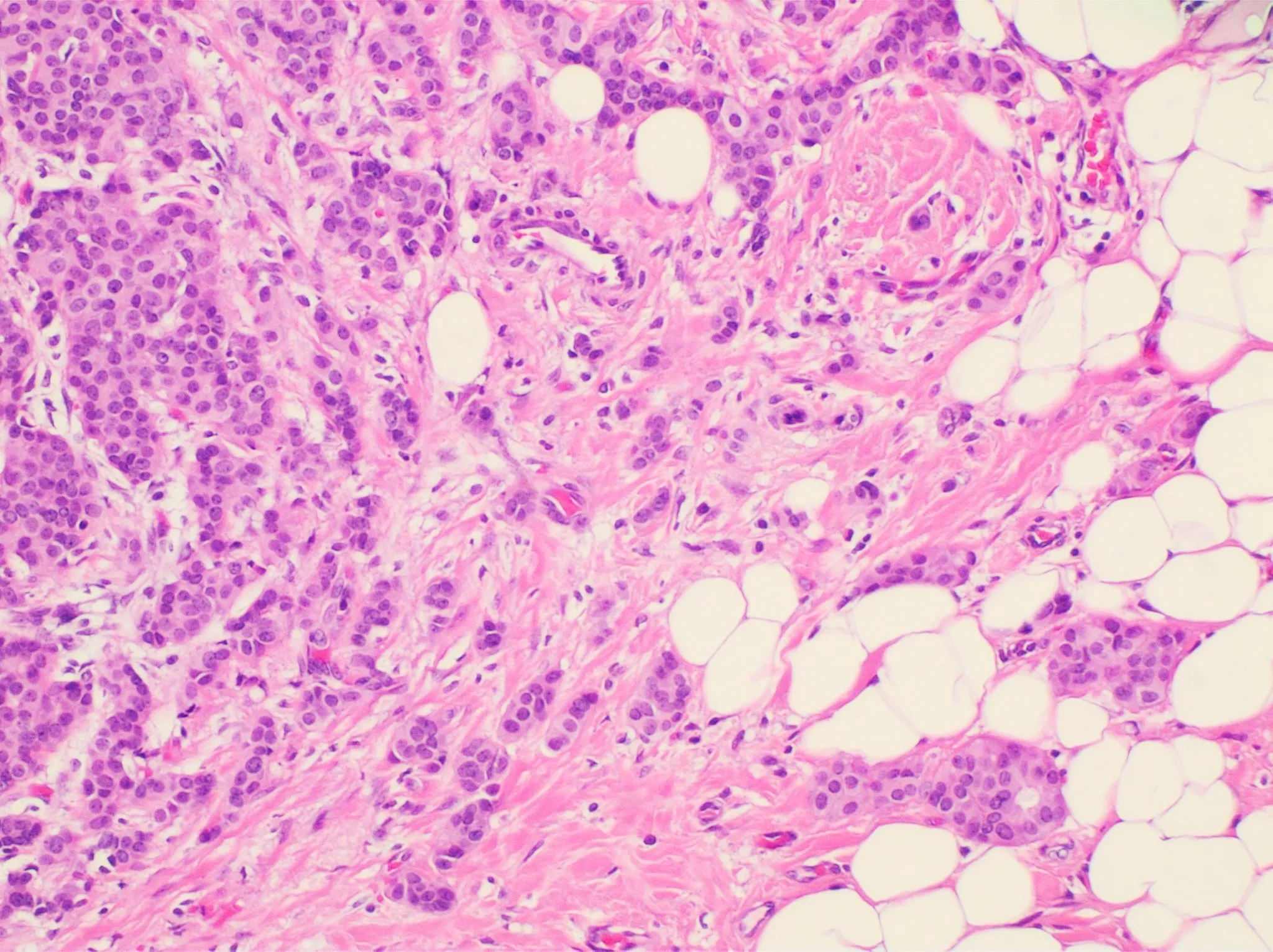 Micrografía de carcinoma ductal infiltrante de mama