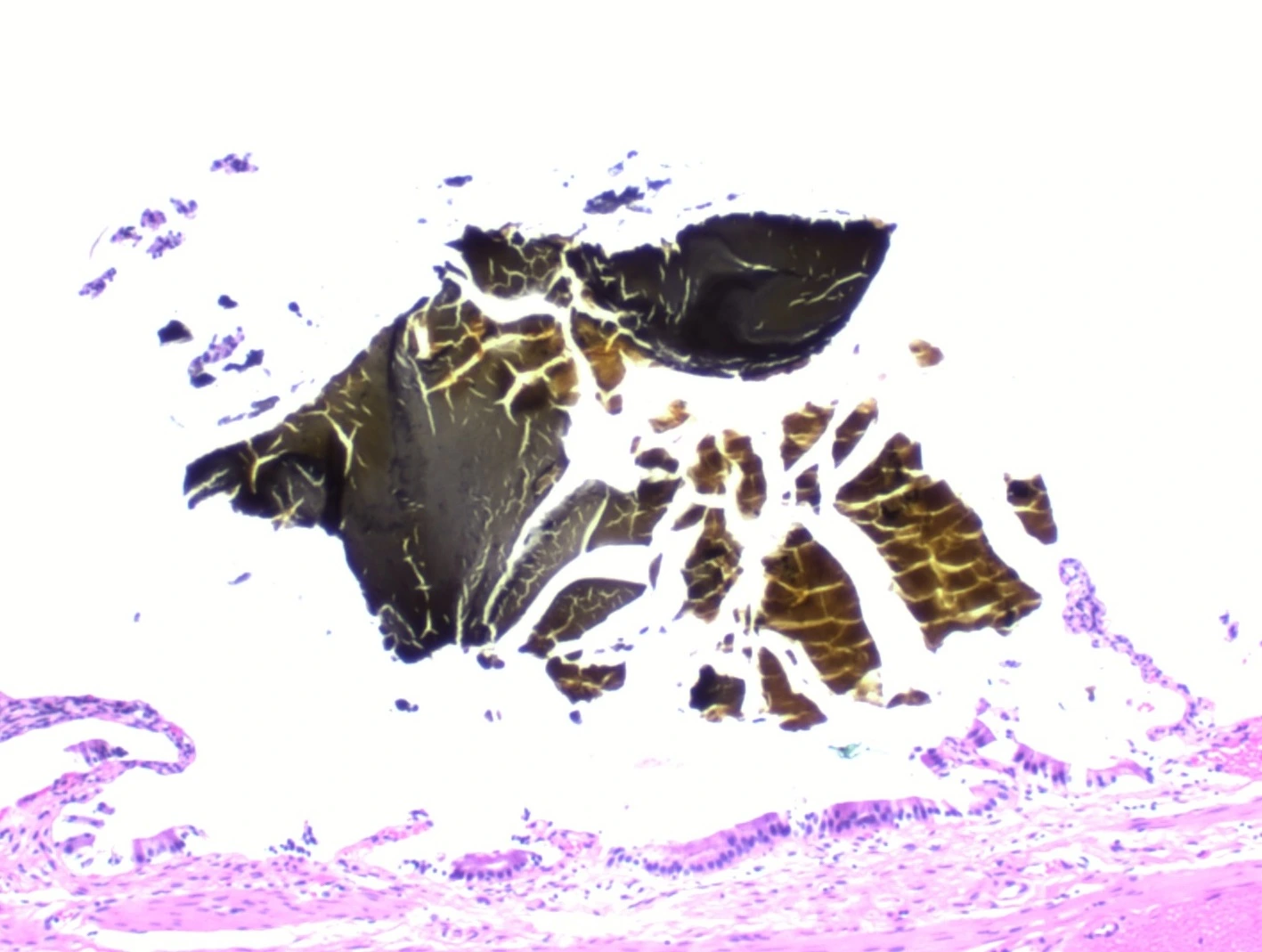 Micrografía H&E de colelitiasis, con fragmentos de cálculo sobre la mucosa de la vesícula biliar