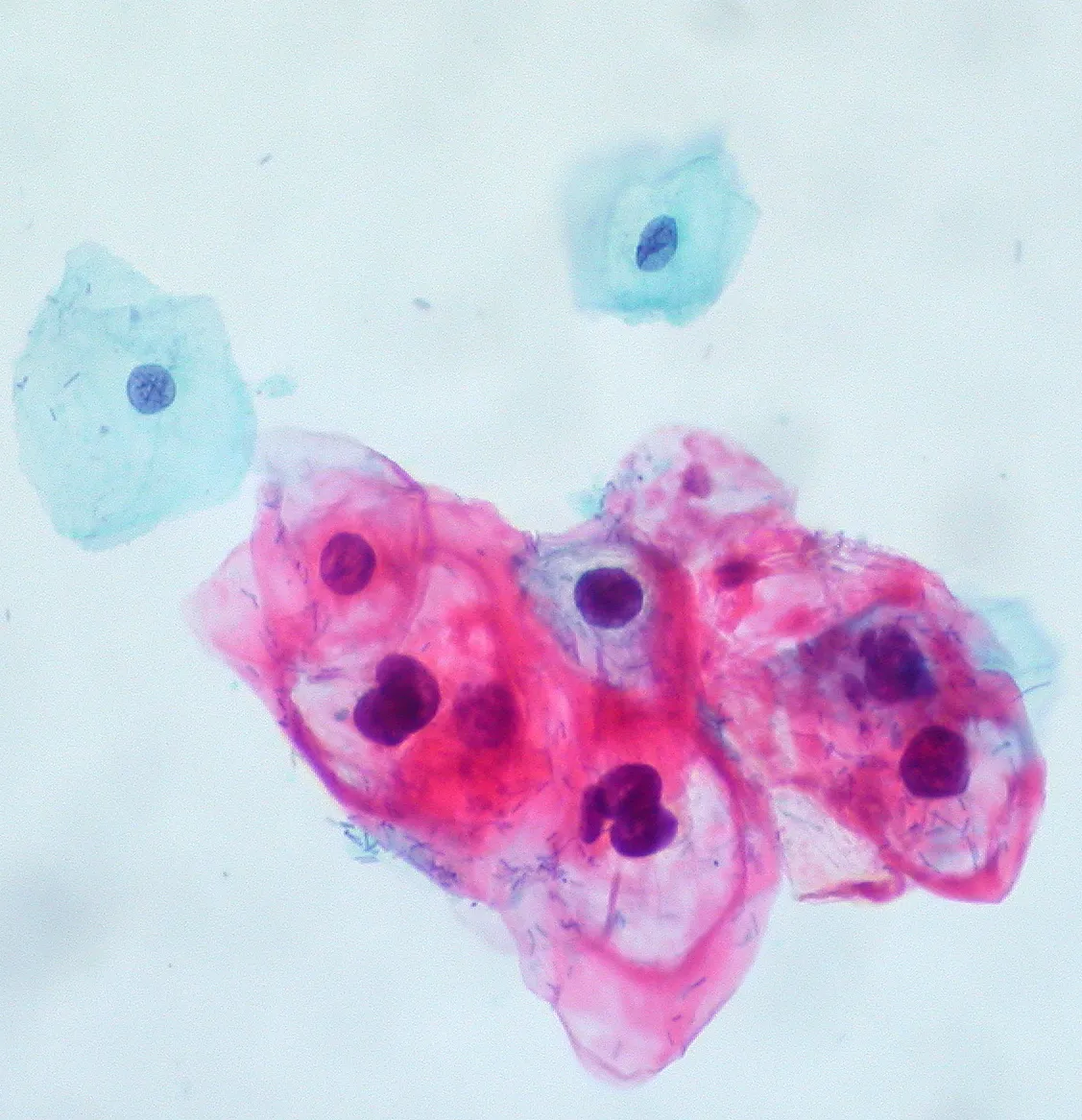 Citología cervical al microscopio: un grupo de células con un hueco claro alrededor del núcleo, junto a dos células escamosas normales