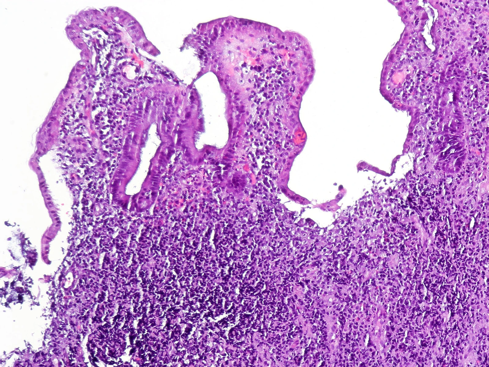 Mucosa de colon con colitis ulcerosa al microscopio: superficie irregular, una cripta alargada y deformada y abajo una masa de células inflamatorias