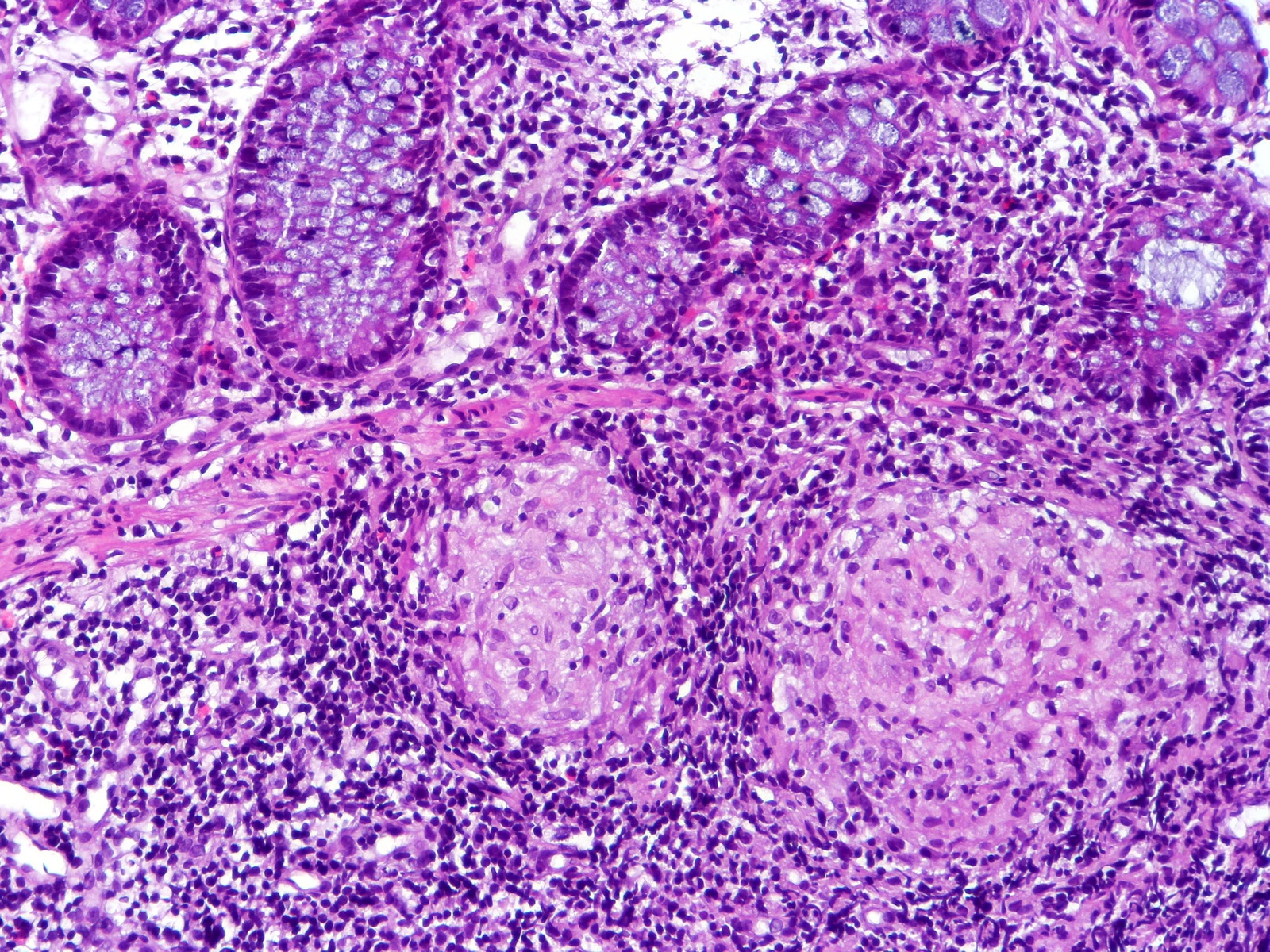 Biopsia de colon con enfermedad de Crohn al microscopio: arriba criptas cortadas de través y abajo dos nidos redondos y pálidos de células rodeados de células oscuras