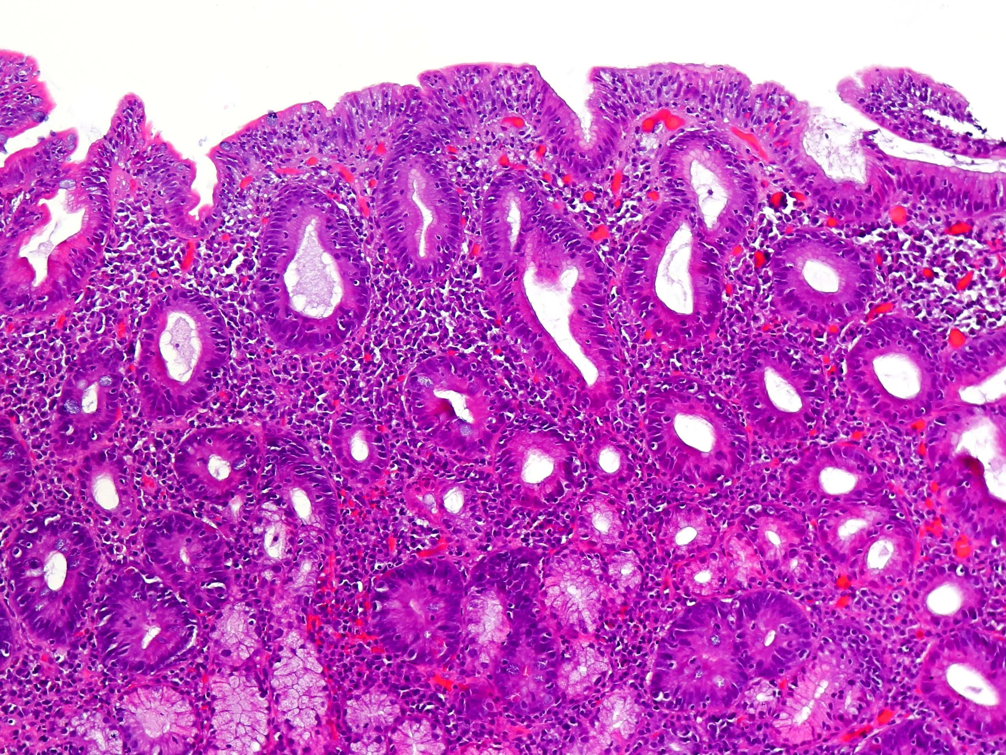 Biopsia de duodeno con enfermedad celíaca teñida con hematoxilina y eosina: superficie casi plana, sin vellosidades, con glándulas alargadas debajo