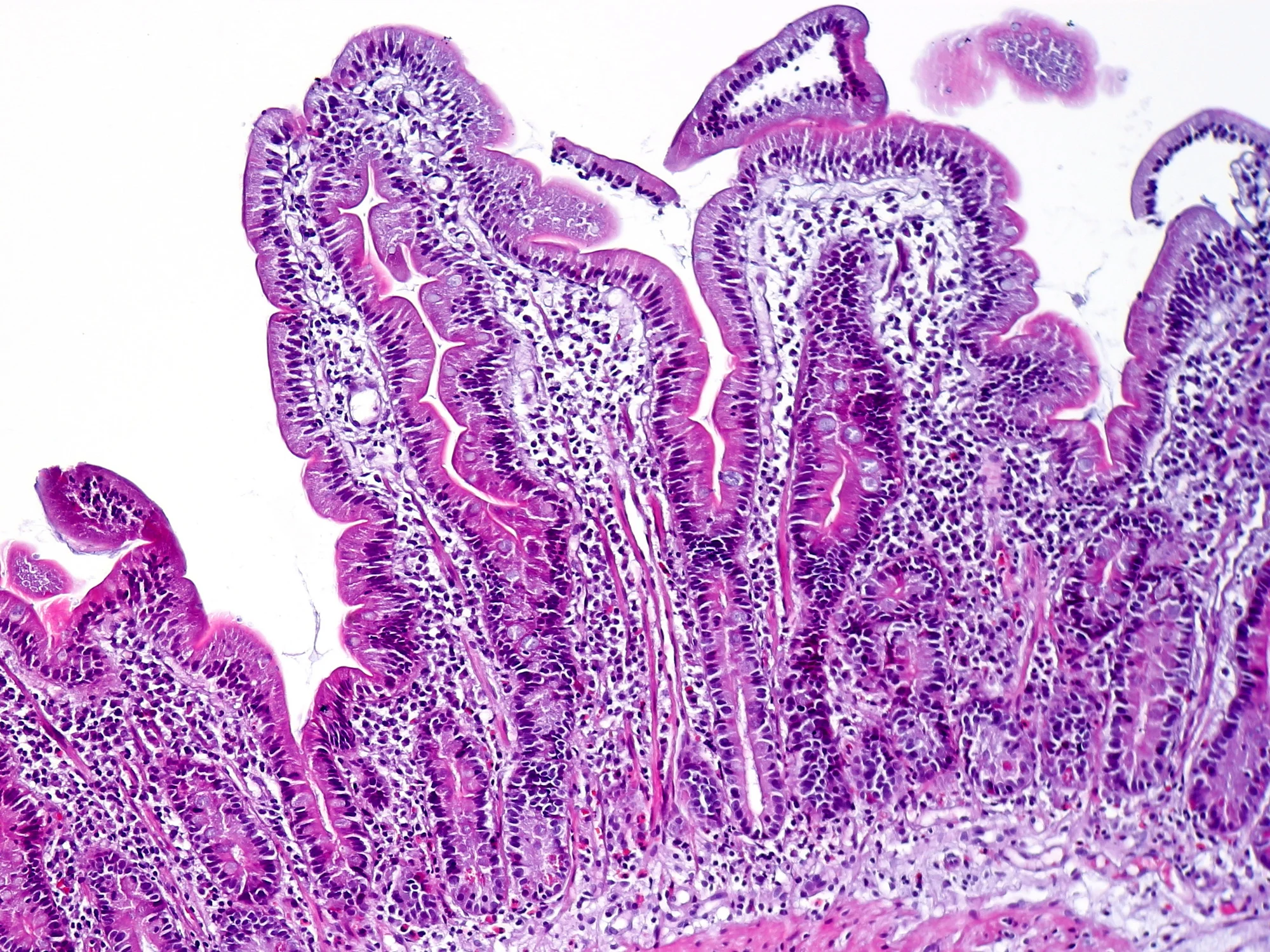 Biopsia de duodeno humano sano teñida con hematoxilina y eosina: vellosidades altas en forma de dedos, cubiertas por una capa continua de células