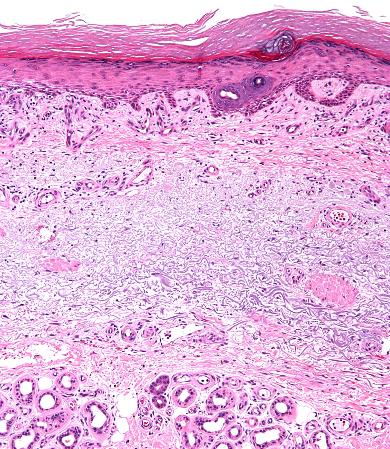 Micrografía H&E de piel con elastosis solar, el daño que deja el sol acumulado en la dermis