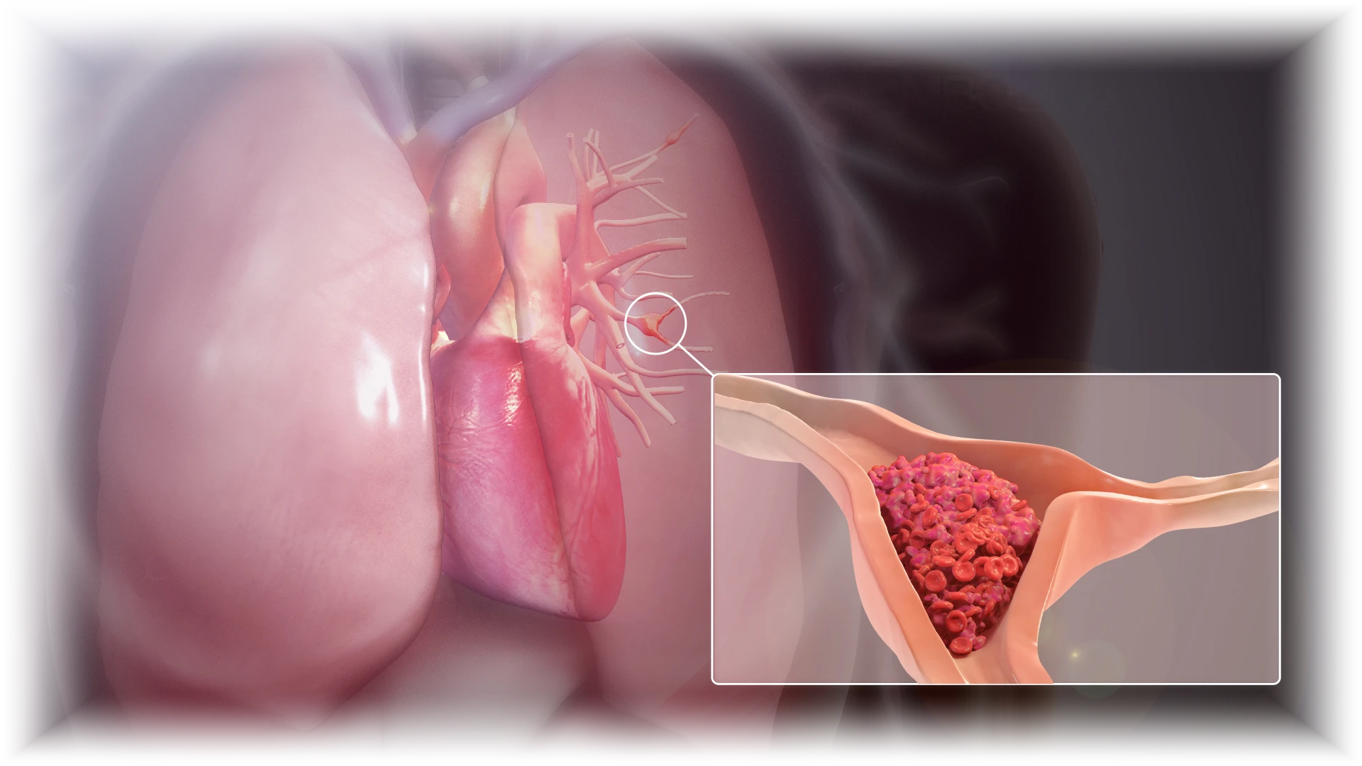Ilustración del corazón y los pulmones: un círculo marca una rama de la arteria pulmonar y un recuadro ampliado muestra un coágulo que la tapa