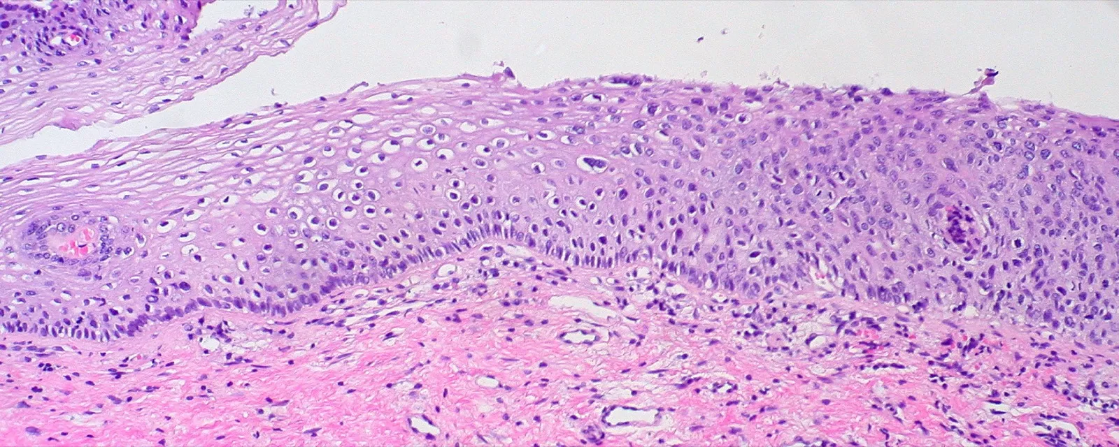 Corte de cuello uterino al microscopio: el epitelio escamoso pasa de maduro y claro, a la izquierda, a oscuro y apretado en casi todo su grosor, a la derecha