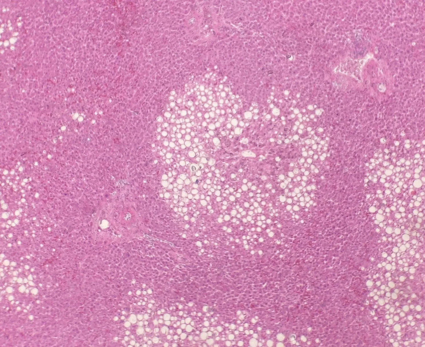 Micrografía de hígado graso con gotas de grasa dentro de las células hepáticas