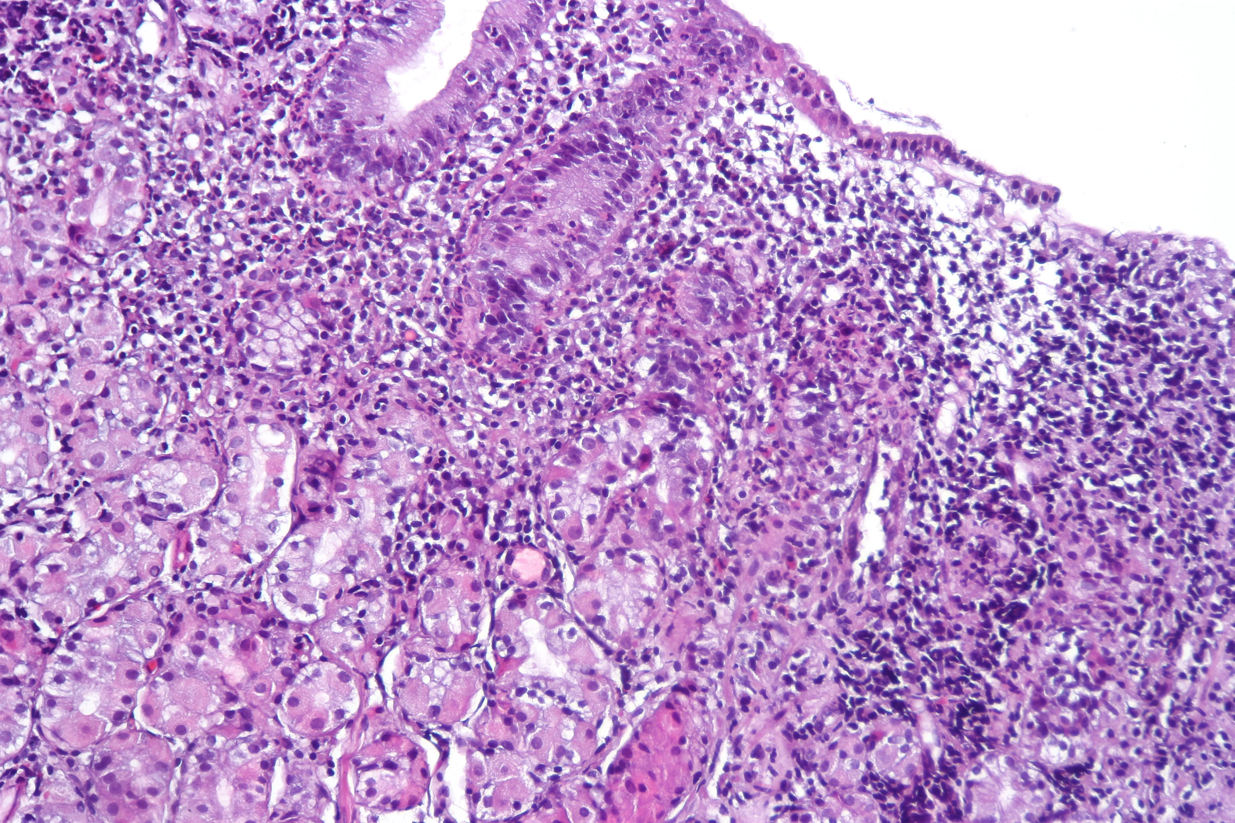 Micrografía H&E de mucosa gástrica con gastritis asociada con Helicobacter pylori