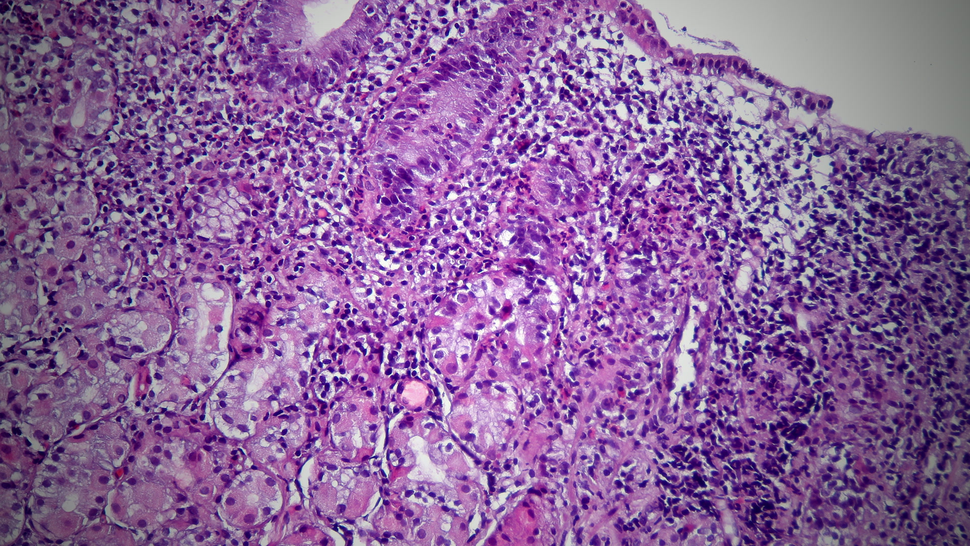 Portada del viaje visual: Gastritis por H. pylori: así cambia el estómago