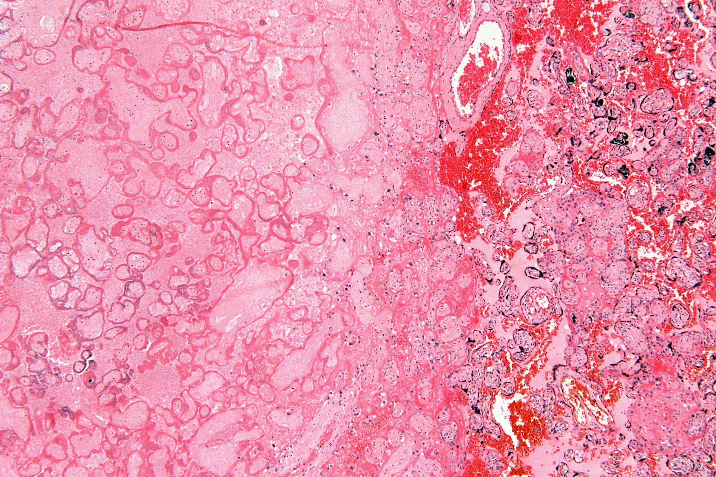 Infarto placentario con hematoxilina y eosina: a la izquierda tejido pálido sin núcleos; a la derecha vellosidades con núcleos morados y sangre roja
