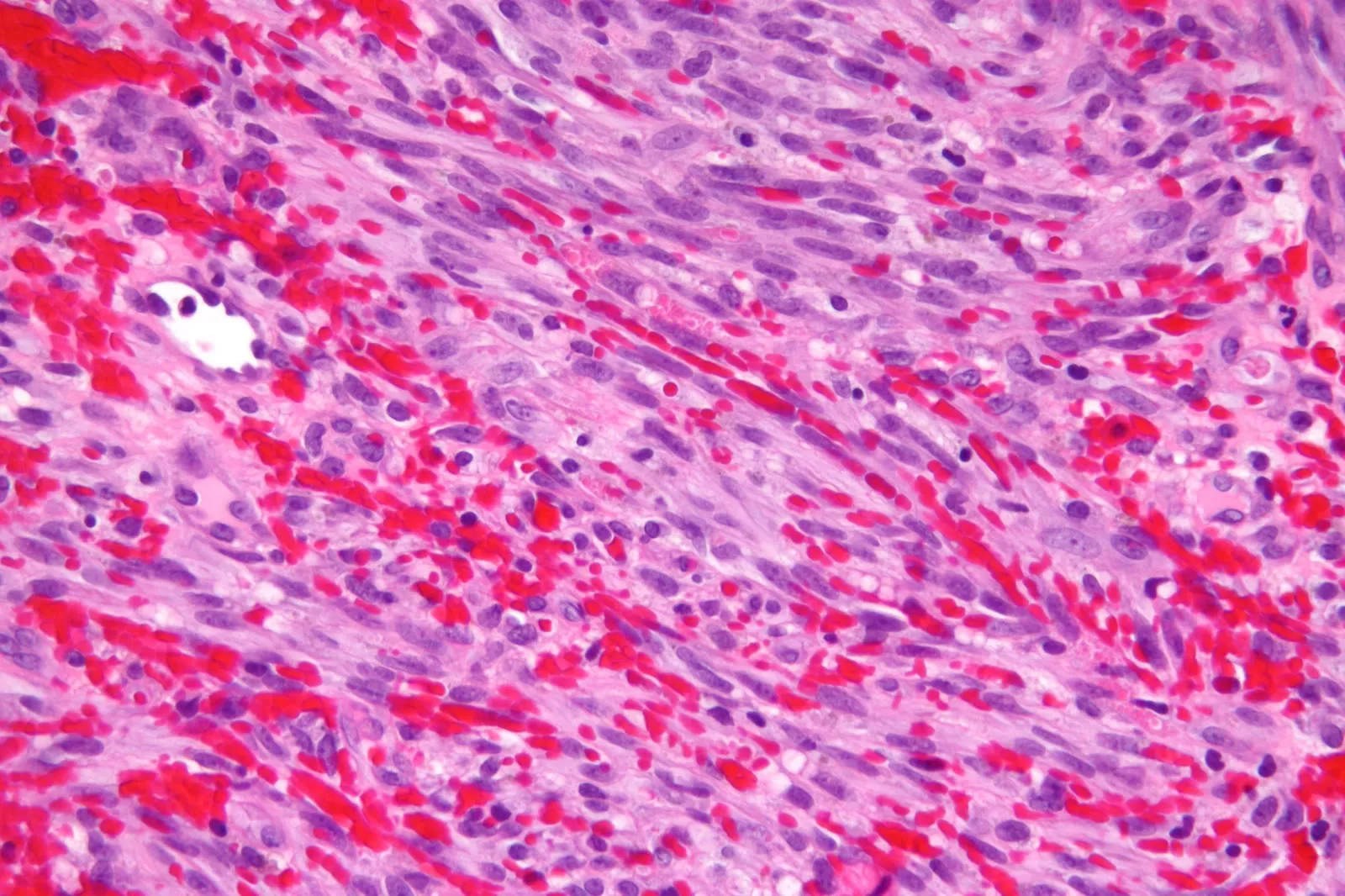 Micrografía de sarcoma de Kaposi con células alargadas y espacios con glóbulos rojos