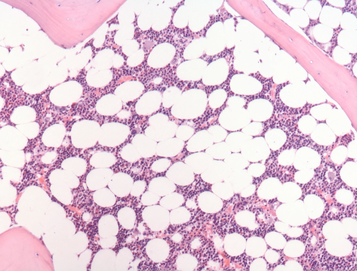 Médula ósea humana con tejido hematopoyético morado entre adipocitos
