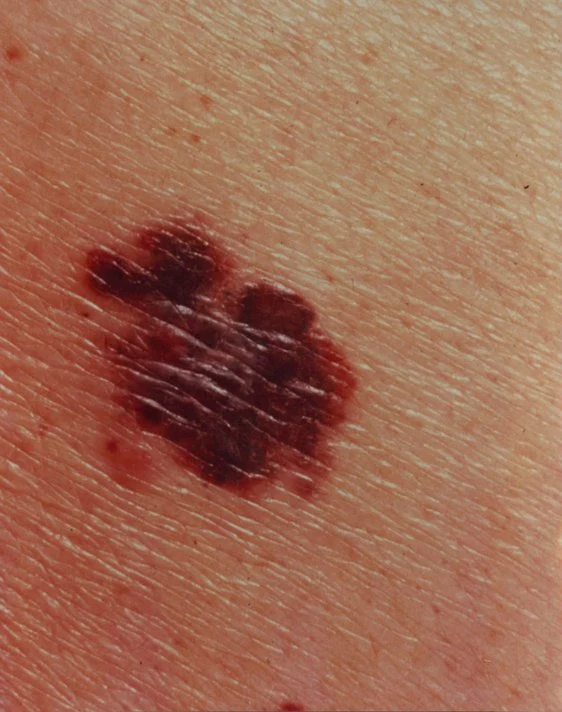 Melanoma con forma asimétrica, bordes irregulares y variación de color