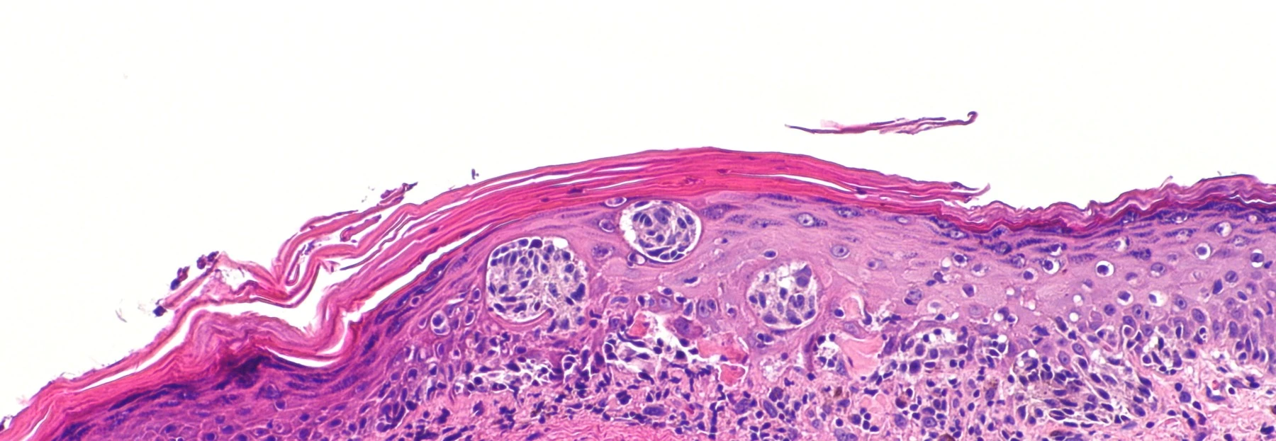 Melanoma in situ teñido con H&E, con melanocitos atípicos que ascienden por la epidermis