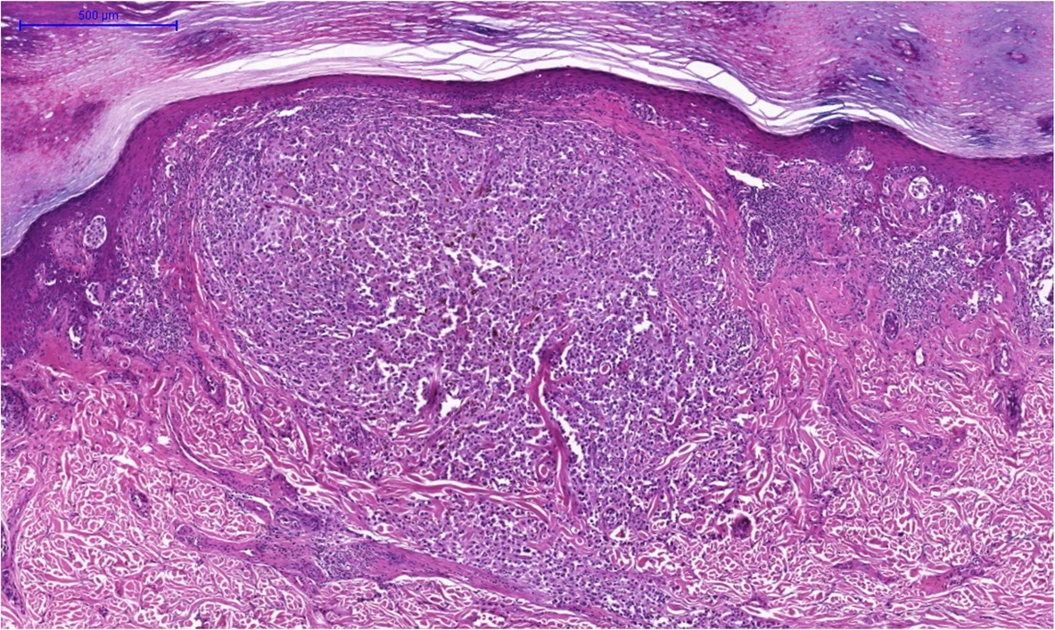 Melanoma invasor teñido con H&E, con un nódulo de células tumorales que se extiende dentro de la dermis