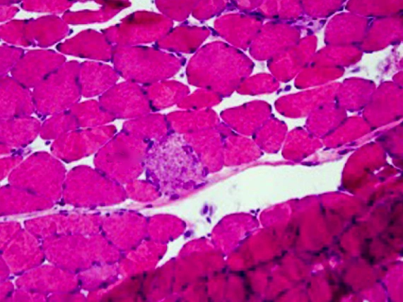 Biopsia de músculo teñida con hematoxilina y eosina: fibras rosadas con forma de polígono y, al centro, una fibra pálida y granular señalada como necrótica