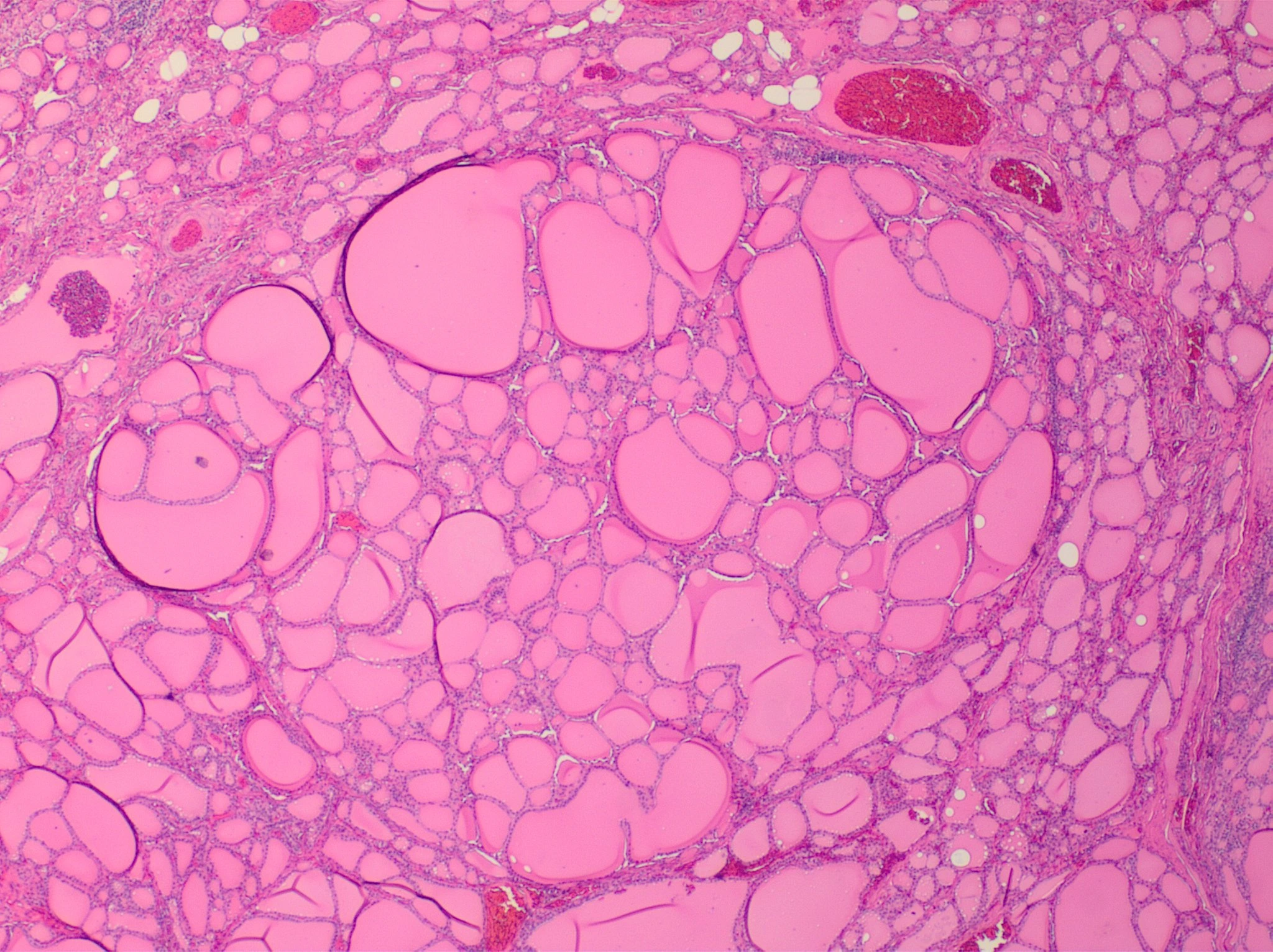 Micrografía H&E de un nódulo hiperplásico benigno de tiroides con folículos de tamaños variados