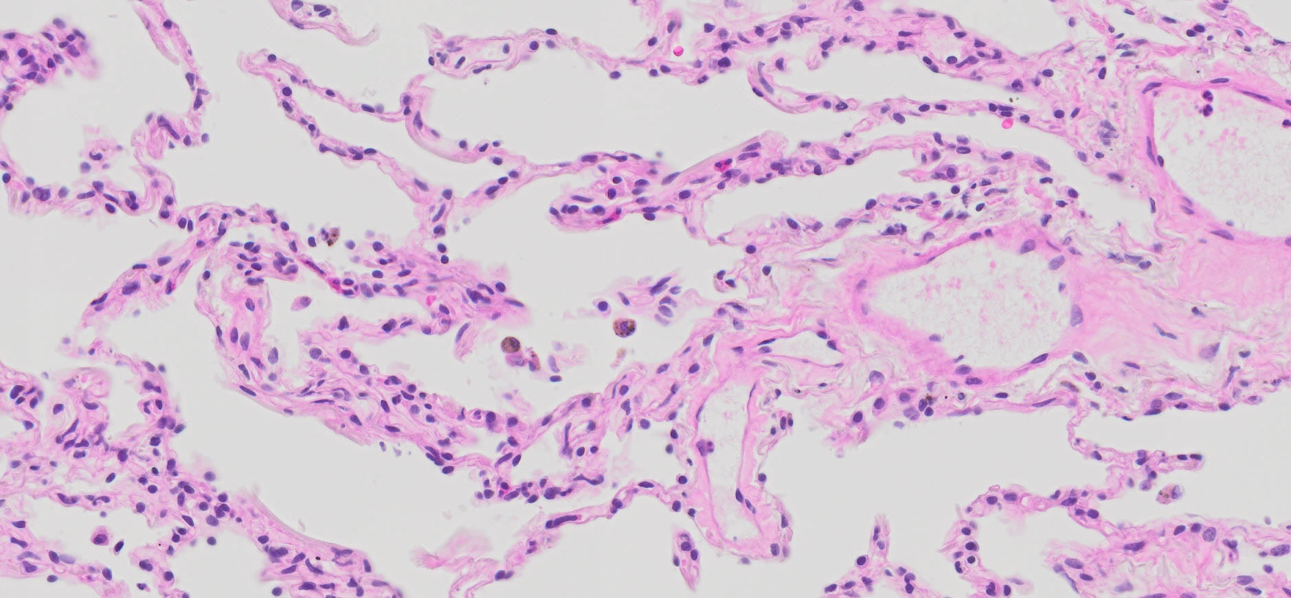 Dos espacios alveolares separados por un tabique delgado en pulmón humano