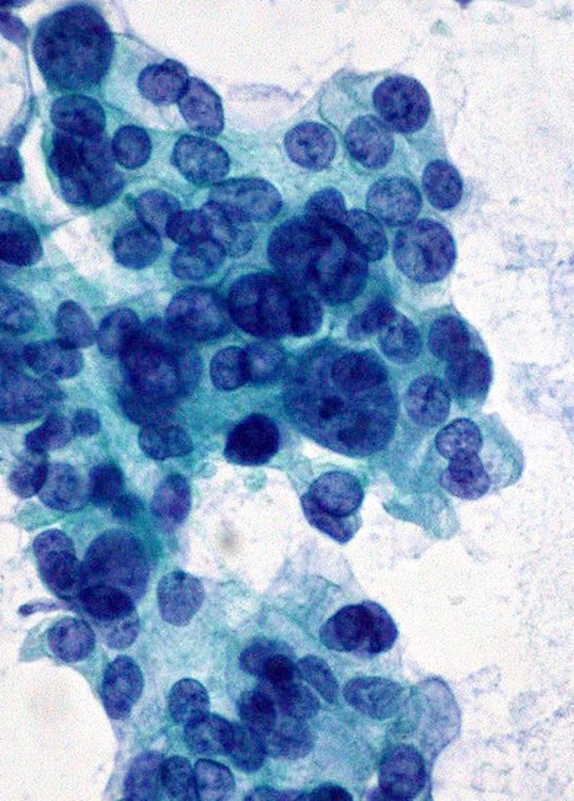 Aspirado de páncreas, tinción no especificada por la fuente: un grupo amontonado de células de adenocarcinoma, con núcleos grandes, desiguales y encimados, sin separación pareja