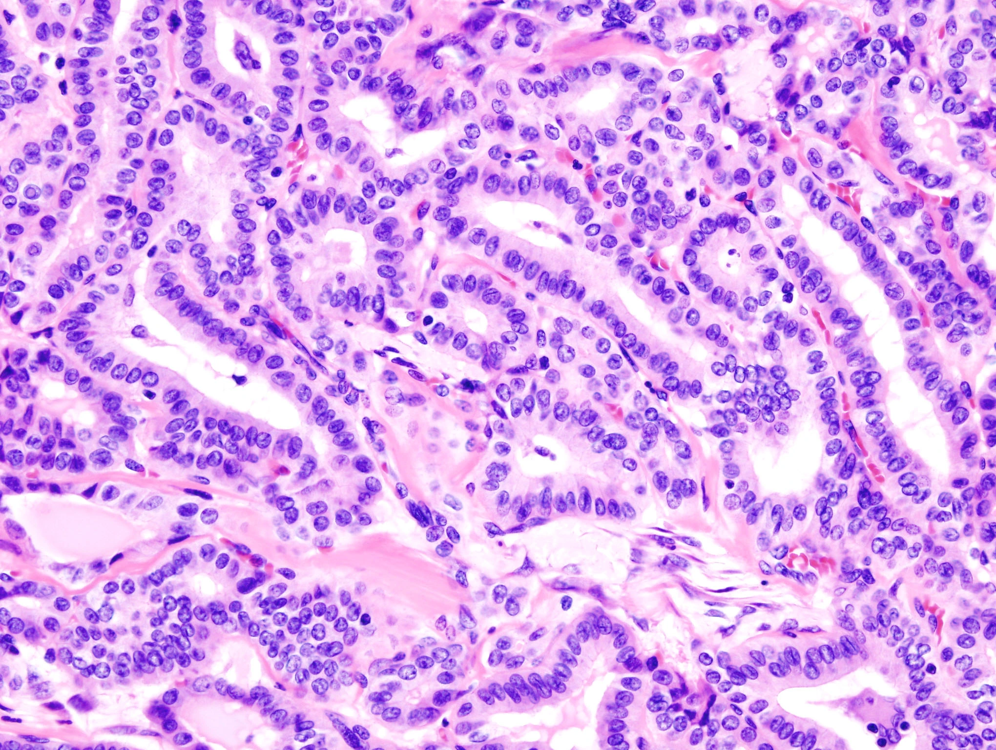 Micrografía H&E de carcinoma papilar de tiroides con células amontonadas sobre pliegues de tejido