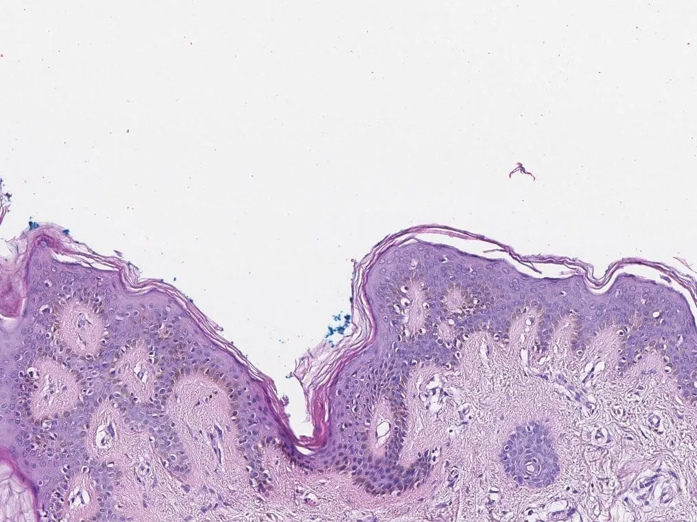 Piel normal al microscopio, con la epidermis arriba y la dermis debajo, teñida con hematoxilina y eosina
