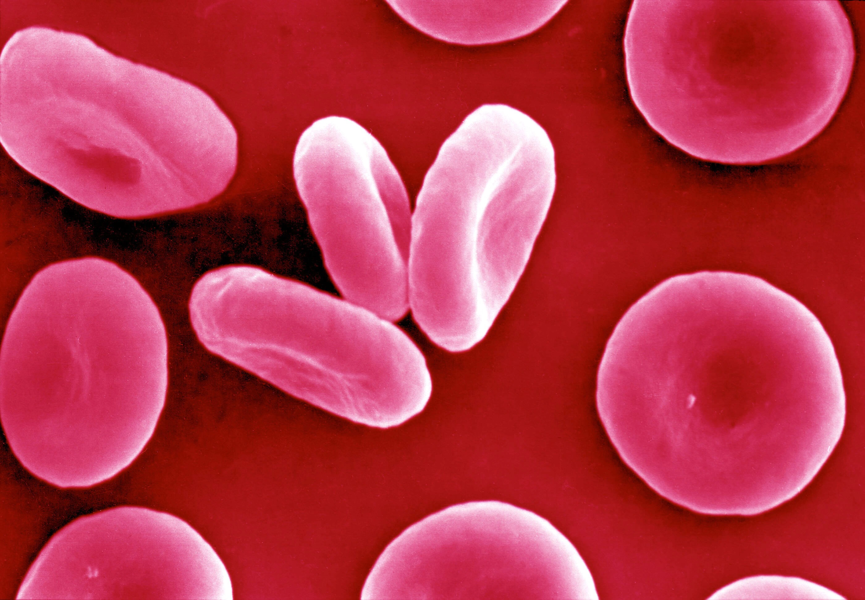 Glóbulos rojos con forma de disco hundido en el centro, en una micrografía electrónica coloreada por la fuente