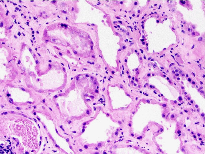Biopsia de riñón con rabdomiólisis teñida con hematoxilina y eosina: túbulos dilatados de pared delgada con material granular adentro