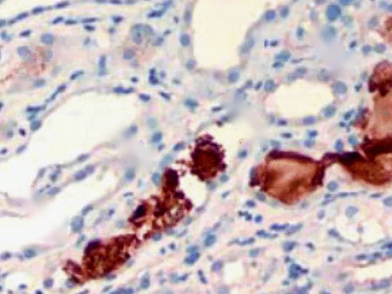Inmunohistoquímica para mioglobina en la misma biopsia de riñón: cilindros teñidos de café dentro de los túbulos