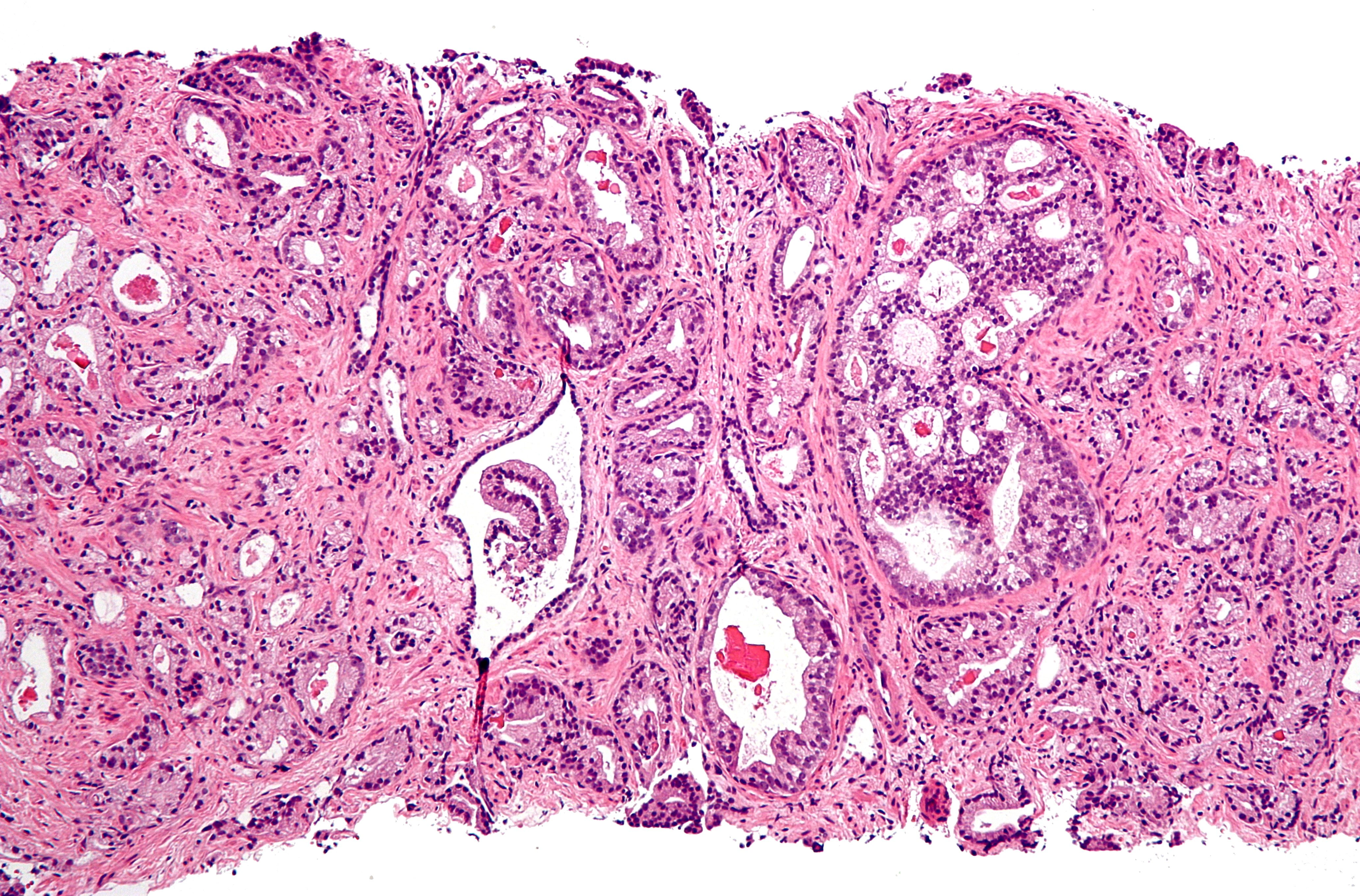 Adenocarcinoma de próstata: varias luces dentro de un grupo continuo de glándulas de formas irregulares.