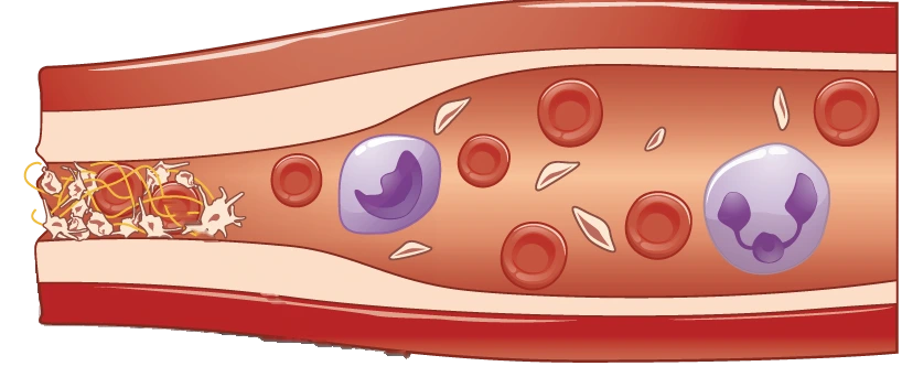 Ilustración del extremo roto de un vaso sanguíneo sellado por un tapón de plaquetas que sostienen hilos amarillos de fibrina; dentro del vaso circulan glóbulos rojos y blancos