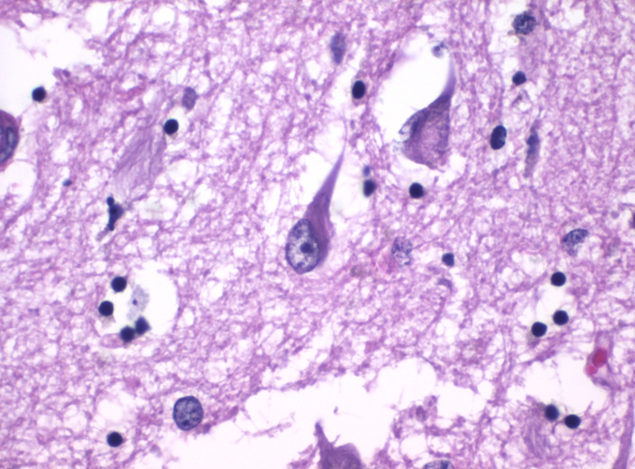Micrografía H&E de ovillos neurofibrilares en el hipocampo con Alzheimer
