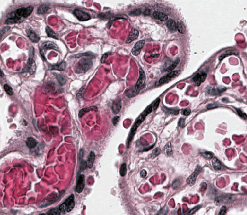 Vellosidades terminales de una placenta sana teñidas con hematoxilina y eosina: núcleos morados y capilares llenos de glóbulos rojos