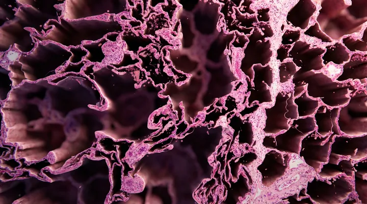Enfisema: cuando los alvéolos pierden sus paredes