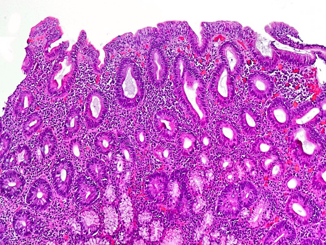 Duodeno con enfermedad celíaca al microscopio