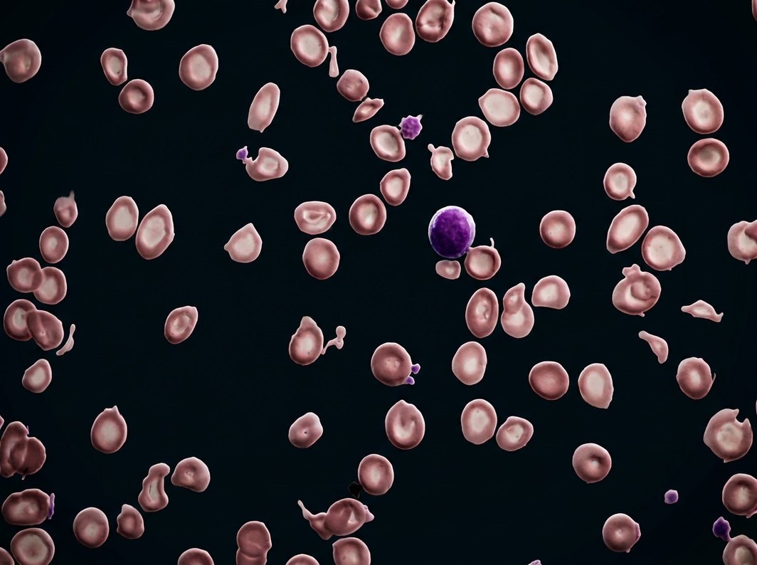 Sangre con falta de hierro al microscopio