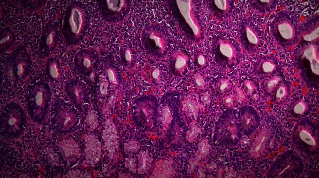 Duodeno con enfermedad celíaca al microscopio