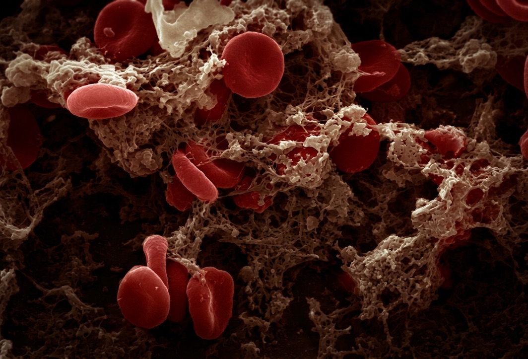 Glóbulos rojos atrapados en una malla de fibrina, al microscopio electrónico