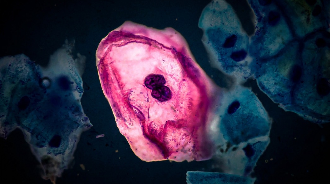 Un coilocito en citología cervical: la huella del virus del papiloma, al microscopio